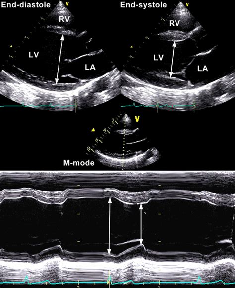 lv size echo|left internal dimension in systole.